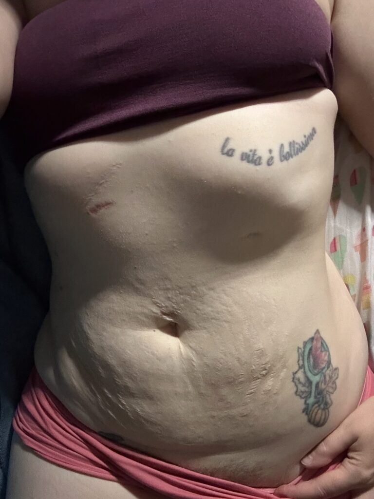close up of woman's scarred up torso to make things intimate